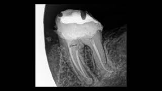 Management of severely calcified canals#endo #calcified #rootcanal