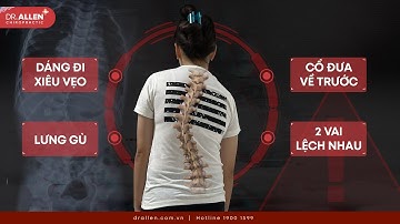 Trẻ phải đối mặt biến chứng gì nếu trì hoãn điều trị cong vẹo cột sống?