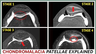 Chondromalacia patellae - The 4 stages and their treatment explained