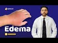 Edema  medicine lectures  medical student education  vlearning  sqadiacom