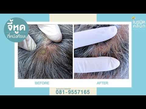 รักษาหูด EP.3 / จี้หูดที่หนังศีรษะ @หมอปุ๊ Neramit Clinic