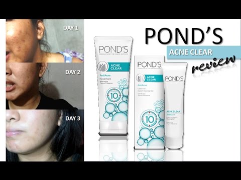 Pond&#;s Acne Clear Review ( Day Challenge) | OhMyYnah