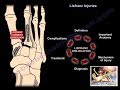 Lisfranc Injuries - Everything You Need To Know - Dr. Nabil Ebraheim