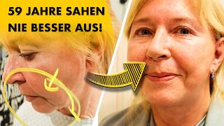 Unglaublich schönes Kinn nach "Fächer" Facelift!