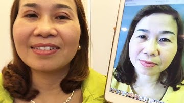 Kết Quả Cắt Mí Mani Open Deep 5D Sau 7 Ngày Tại Dr.Hải Lê.