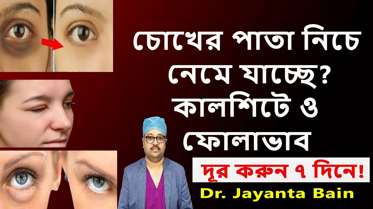 চোখের পাতা নিচে নেমে গেলে করনীয় কী? চোখের তলার কালশিটে ও ফোলাভাব দূর করার উপায় | Dr. Jayanta Bain