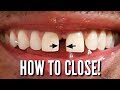 Orthodontic closing springs (Diastema) lesson