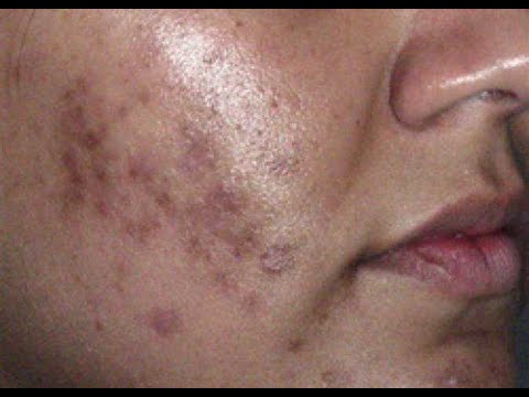 علاج ندبات حب الشباب ، التنقر ، البقع البنية ، البقع الحمراء ، Acretin La Roche-Effaclar Youtube