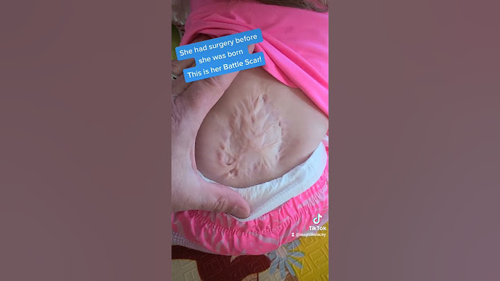 My daughter had surgery before she was born. #Spinabifidaawareness #spinabifidawarrior