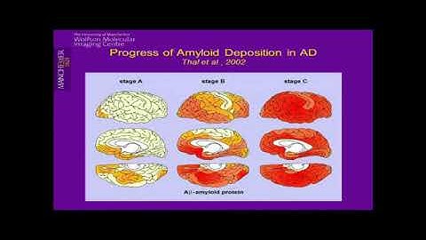 Pathophysiology and Imaging of Neurodegenerative Diseases