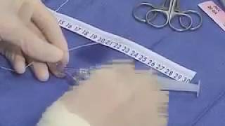 PICC Line Placement in the Neonate | Part - 1