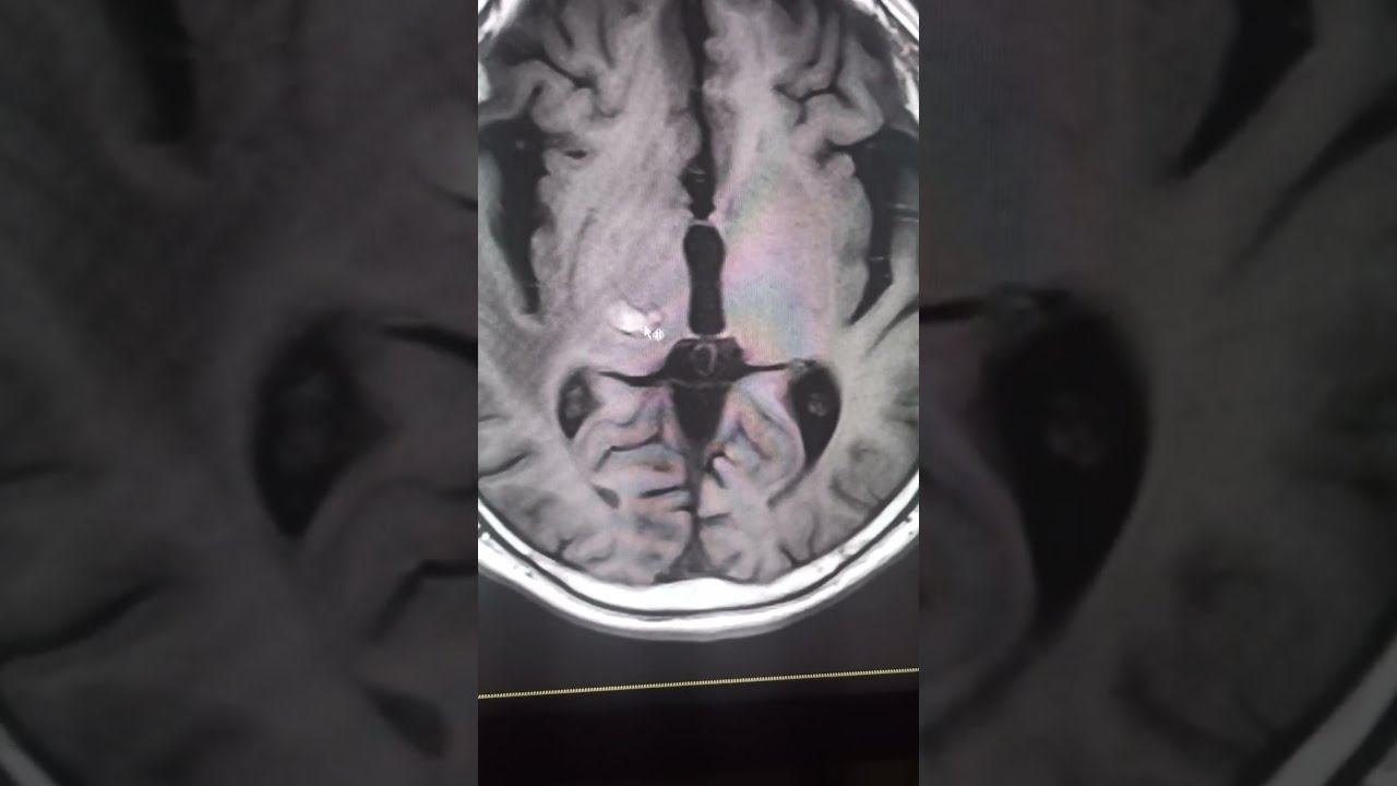 Ventricular Pathology Mri