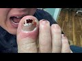 Don&#39;t Pick or Chew on your Toe Nails!