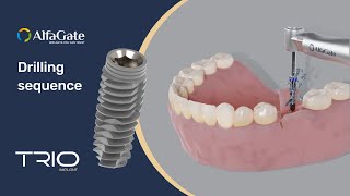 How to place Trio dental implant drilling sequence | Alfa Gate