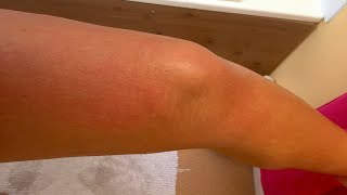 PLEASE HELP ME TO GET THE TREATMENT I NEED! #AquagenicPruritus by Niah Selway 5,119 views 3 years ago 3 minutes, 41 seconds
