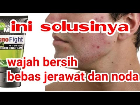 GARNIER  GEN BISA SEMBUHIN JERAWAT ?. 