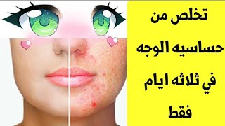 طريقه للتخلص من حساسيه الوجه واحمرار الجلد | احصل على بشره ناعمه وصافيه