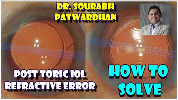 183 Solving refractive surprise by rotation of Toric IOL Dr Sourabh Patwardhan
