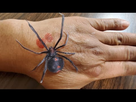 Vídeo: Picadura De Araña 