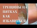 Трещины на пятках, как избавиться. Рефлексология стоп.