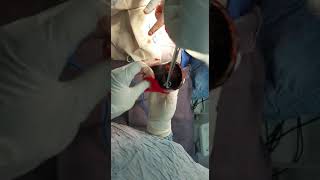 استخراج كباية جبنة من بطن مريض عبر عملية جراحية