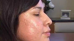 PLASTIC SURGERY:  CROSS ACNE SCARRING TREATMENTS  JOURNEY