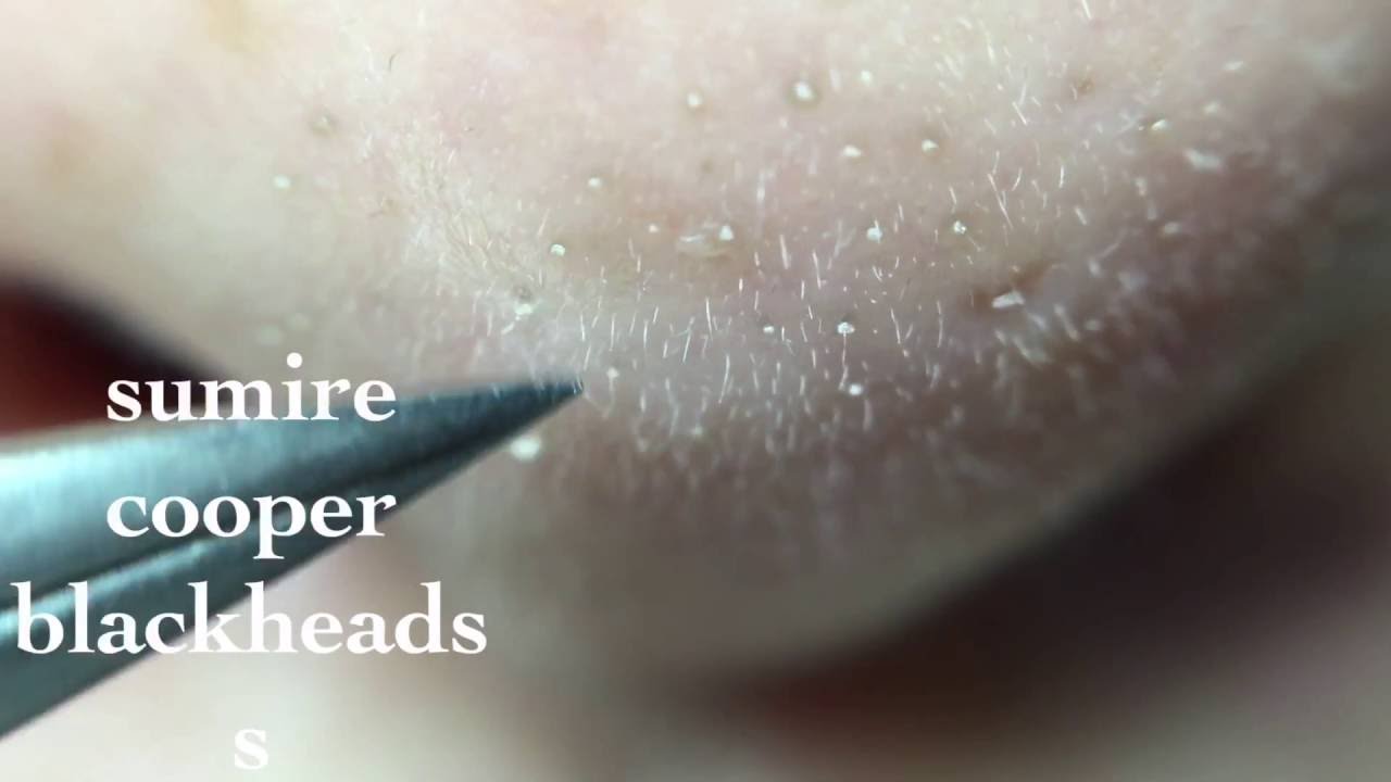 鼻角栓79nose blackheads★Tweezers only★ YouTube
