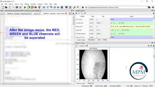 PYTHON 2021 Project - Segmentation and Classification of Diabetic Retinopathy Using Python | DIP