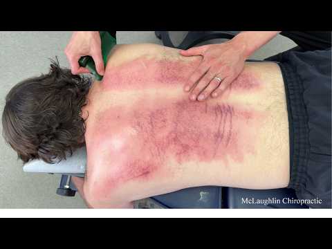 NERVES On Fire 😳 Might Be The WORST Back I've Seen! 23 Year Old Gets CRACKED! Needs HELP - Dr. Ed 💪
