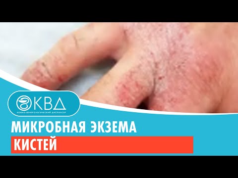 Микробная экзема кистей. Клинический случай №37