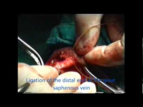 Ligation and stripping of varicose veins - surgical anatomy