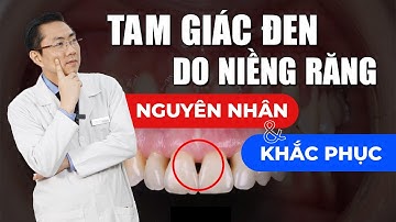 Niềng Răng Bị Tam Giác Đen Nguyên Nhân Và Cách Khắc Phục | Nam Bùi Vinalign