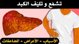 مرض تشمع الكبد : أعراض و اسباب تشمع الكبد مع علامات اضرار تليف الكبد و مخاطر تشمع الكبد