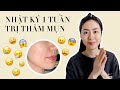 CHU TRÌNH PHỤC HỒI DA THÂM SAU MỤN NHANH NHẸN NHẤT!!! So sánh da mỗi ngày