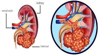 Kidney Tumors: Symptoms, Causes, Diagnosis, and Treatment