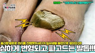 오랜만에 큰거(?) 온다!! 심하게 변형되고 파고드는 내성발톱!! 일상생활 불편함 이제 바이바이! #레푸스 #내성발톱 #무좀발톱 #refuss #toenails #발톱 #발톱무좀