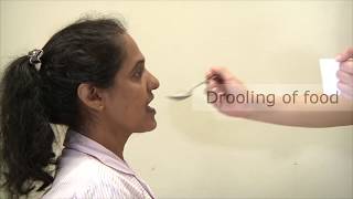 Dysphagia - Signs and symptoms of swallowing disorder