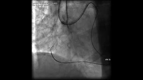 Aortic dissection and radial rupture during retrograde CTO PCI: Management of complications VİDEO 11