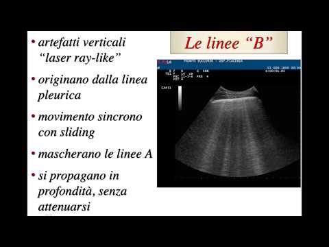 5  Sindrome Interstiziale