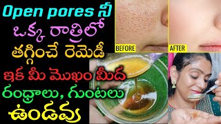 How to Remove open Pores Naturally In Telugu | ఒక్క రాత్రిలోనే మీ మొఖం మీద రంధ్రాలు, మచ్చలు మాయం?