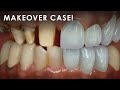 How a dental lab fabricates a makeover case