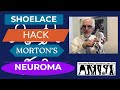 Shoe lace hack to relieve mortons neuroma