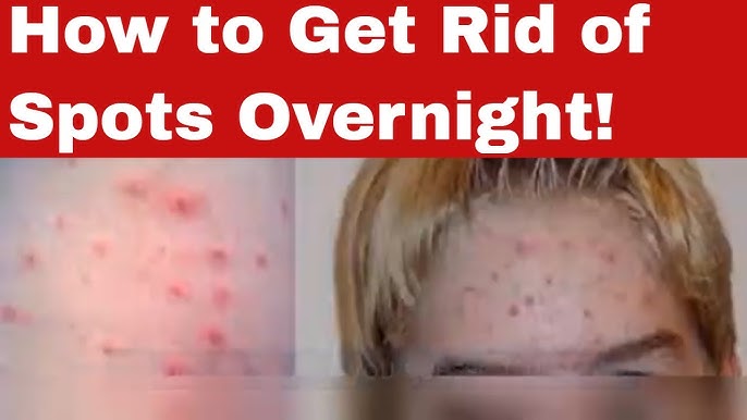5 Ways To Get Rid Of Spots Overnight Your Magical 2024