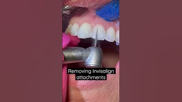 Removing #Invisalign Attachments #invisalignsmile #smilemakeover #teeth #dentist #orthodontics