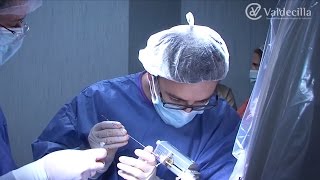 Estimulación cerebral neuropatía