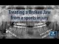 How are jaw fractures from sporting injuries treated