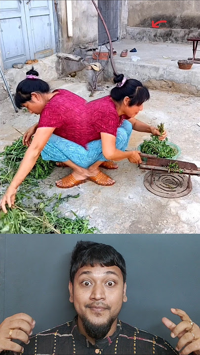 Conjoined Women | Faded Song#shorts#disabled#viralshorts#shortsfeed