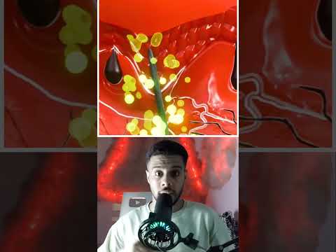 لو دخلت شظية تحت جلدك