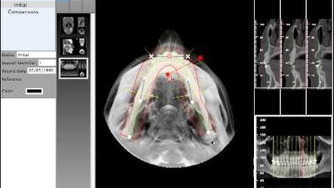 Quick Ceph Studio - Extracing Panoramic View from CT Scan