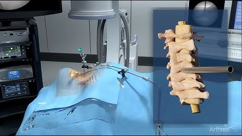 Posterior Cervical Endoscopic Foraminotomy at C4/C5
